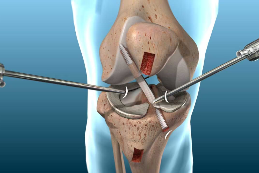 Knee Replacement Model