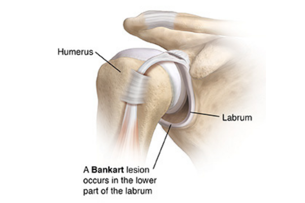 Knee Replacement Model