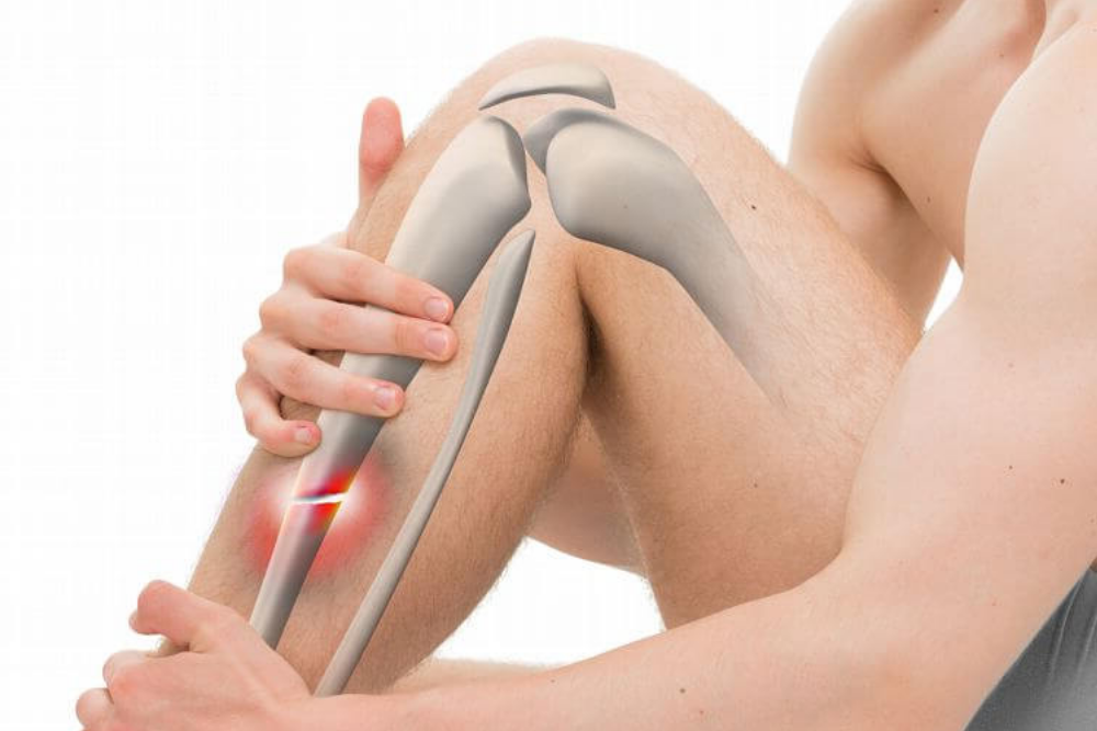 Knee Replacement Model