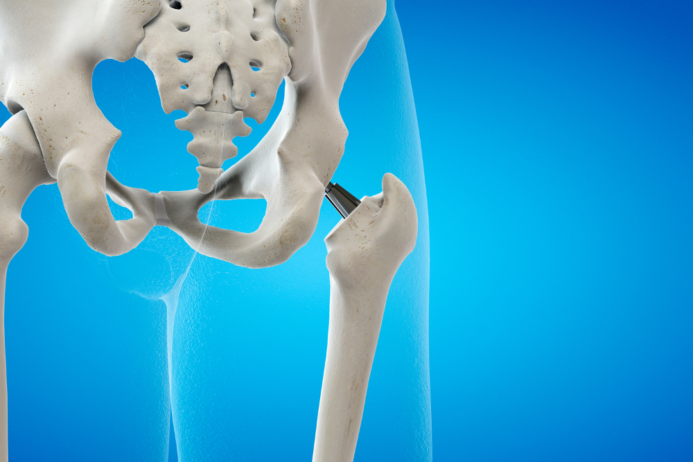 Knee Replacement Model