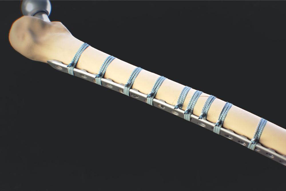 Knee Replacement Model